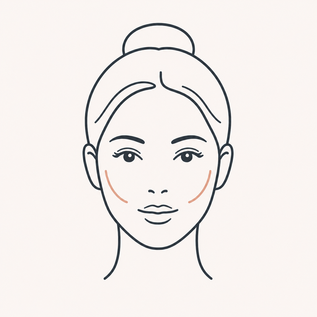 Cheek treatment zone, where the fat pad descends and creates the nasolabial fold below it